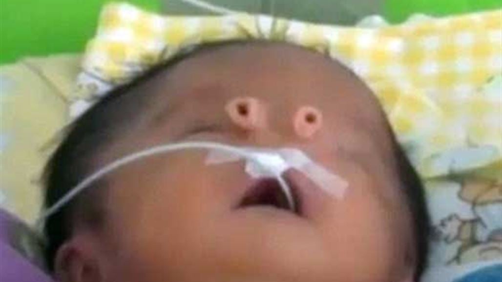 طفل يولد بأنبوبين بدلا من الأنف