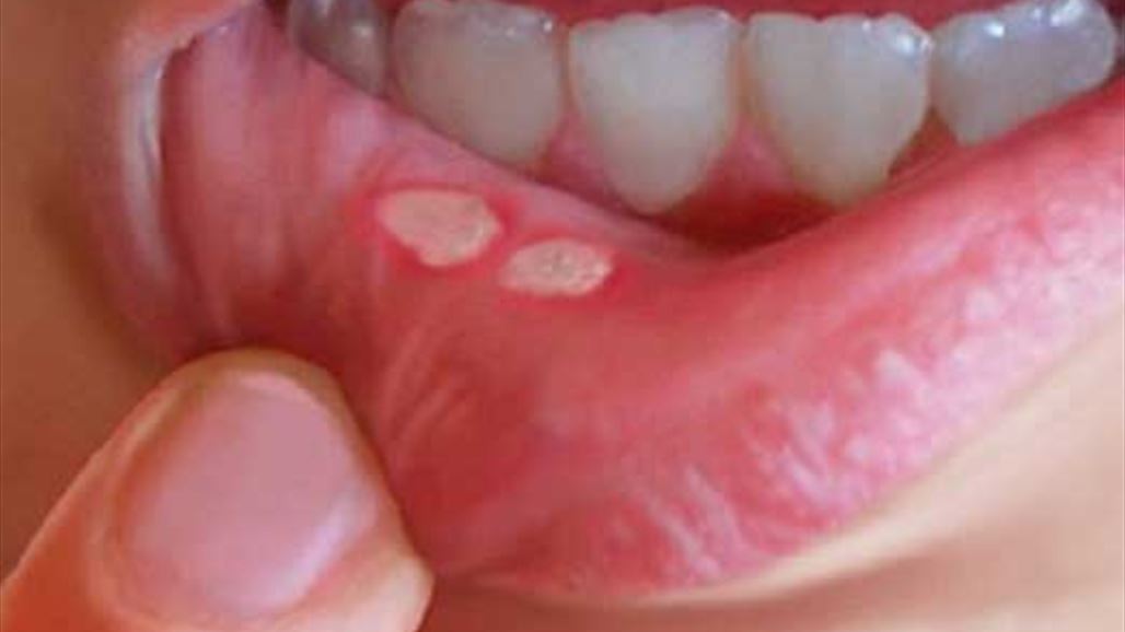 ثلاثة علاجات طبيعية للقضاء على تقرّحات الفم