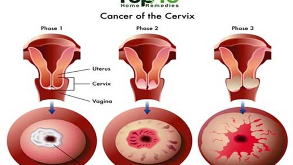 News - 10 Warning Signs of Cervical Cancer You Should Not ...