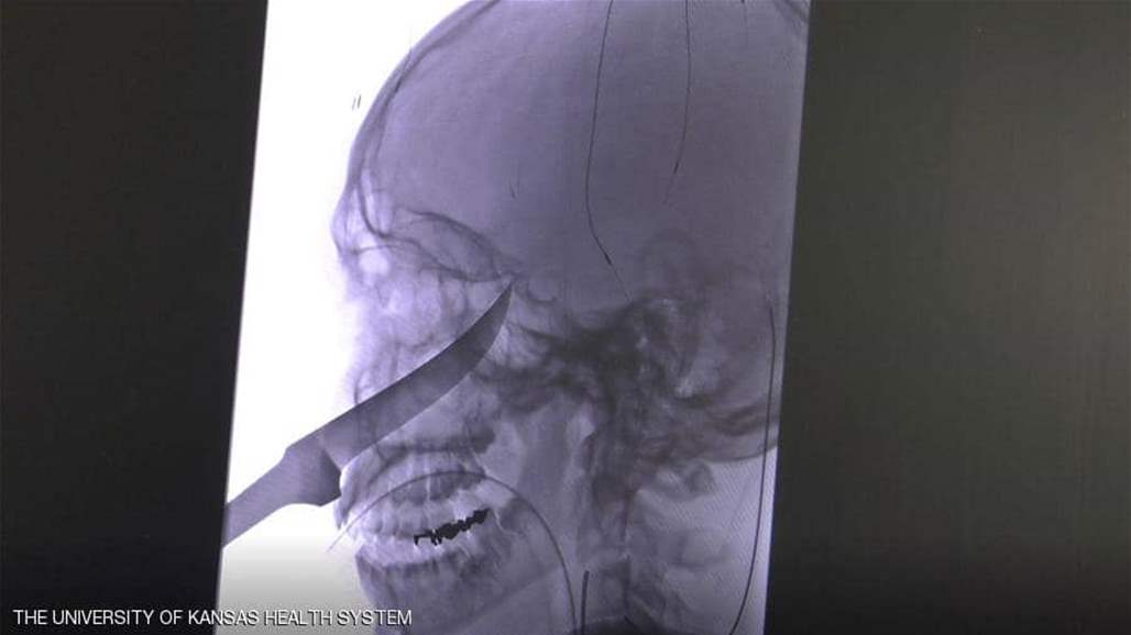 سكين حاد يدخل في جمجمة مراهق، وهكذا نجا...