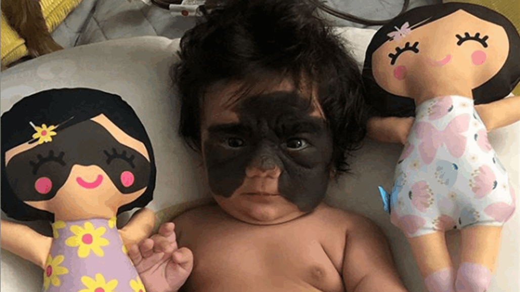 رضيعة تتعرض للسخرية بسبب وحمة "باتمان" على وجهها... و98 ألف دولار لإنقاذها! (صور)