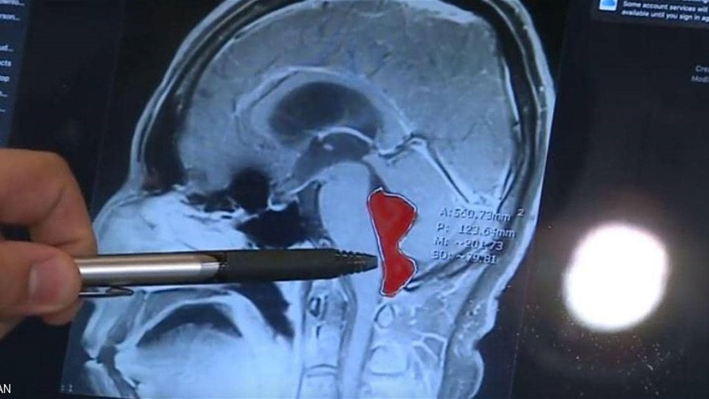 دودة تعيش 10 سنوات في دماغ رجل... كيف دخلت؟