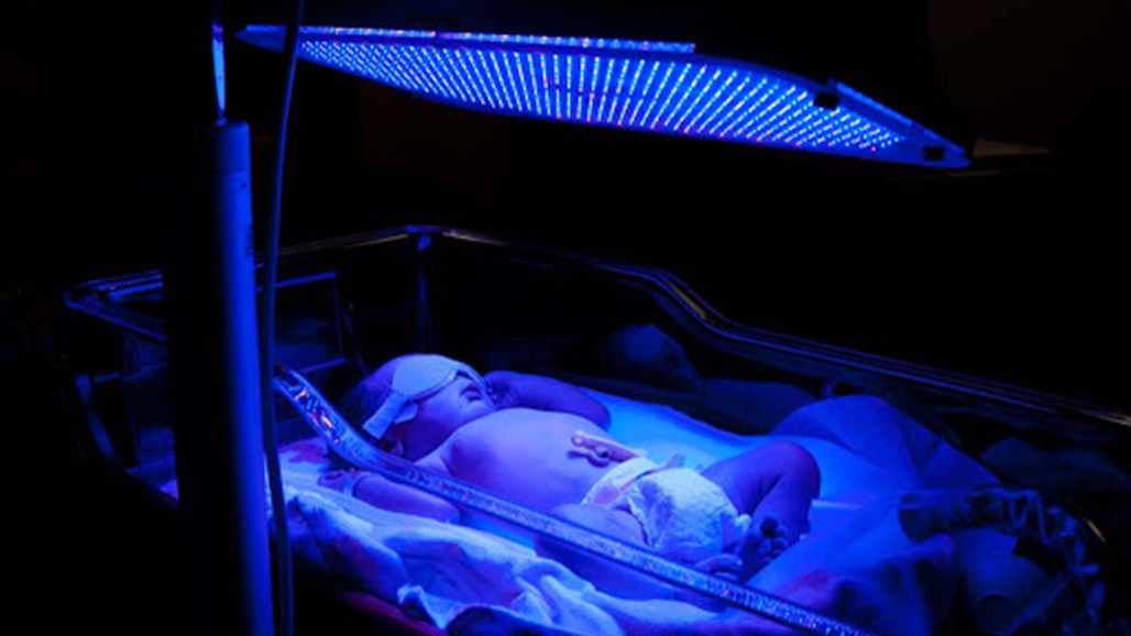 ما هي النسبة الطبيعية للصفار عند حديثي الولادة؟