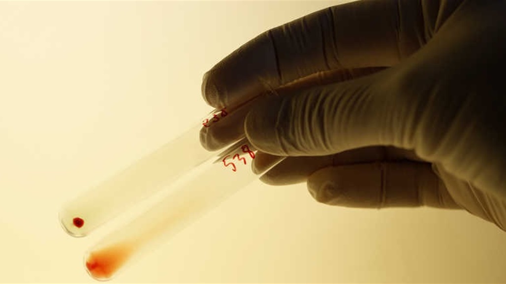 دراسة تكشف عن فصيلة الدم الأكثر عرضة لكورونا