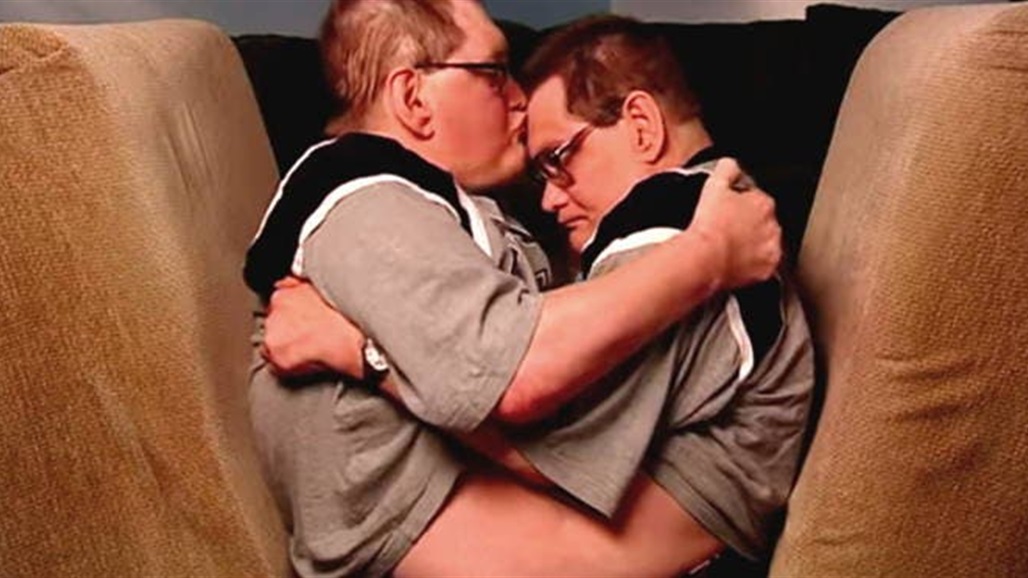 وفاة أكبر توأم ملتصق في العالم عن عمر ناهز 68 عاما