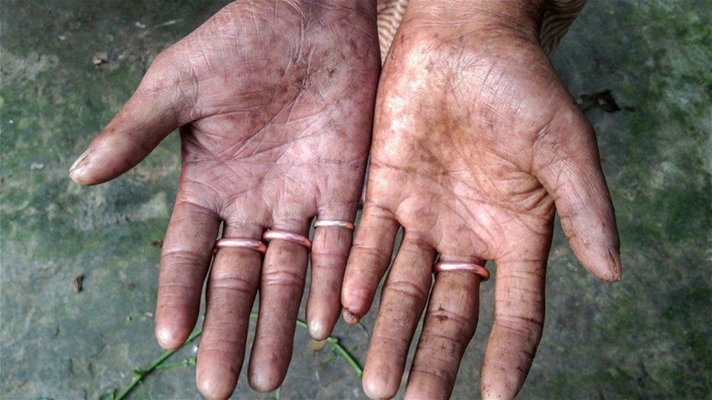 بالصور: عائلة لا تملك بصمات بسبب طفرة جينية!