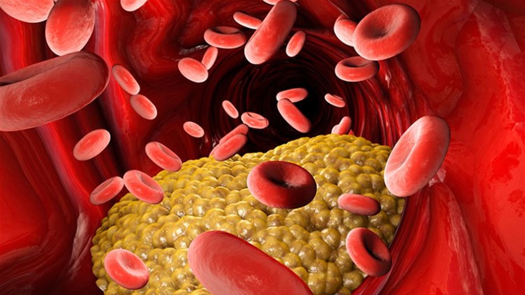 علامتان في وجهك تشيران إلى ارتفاع مستوى الكوليسترول... لا تتجاهلها!
