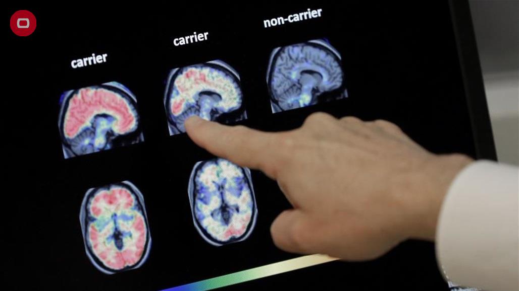 باحثون يعثرون على "مفاجأة" في دماغي مريضين بالزهايمر!