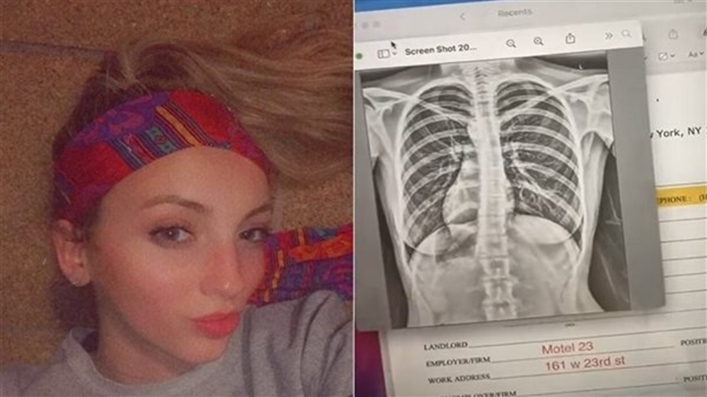 بالصدفة.. فتاة تكتشف أن قلبها في غير مكانه الطبيعي 