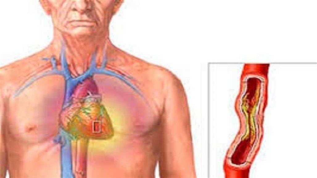 علماء يكتشفون بروتينا يحمي من "تصلب الشرايين"