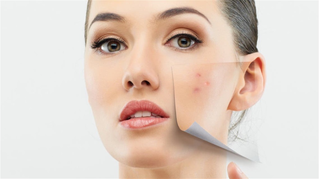 للتخلص من البثور بسرعة... اتبعي هذه النصائح!