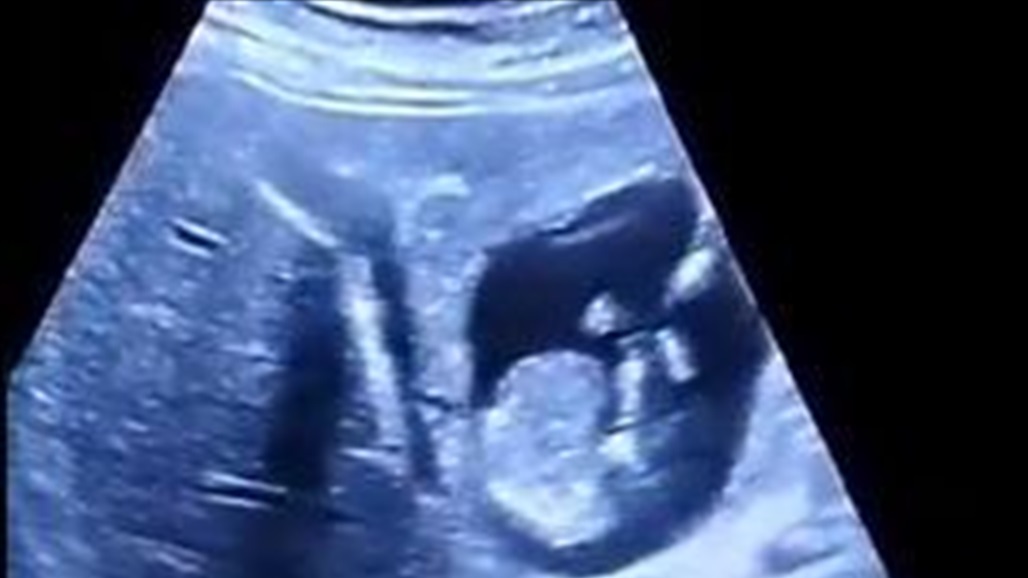 حالة نادرة جدا لامرأة حامل بجنين في الكبد عوضا عن الرحم