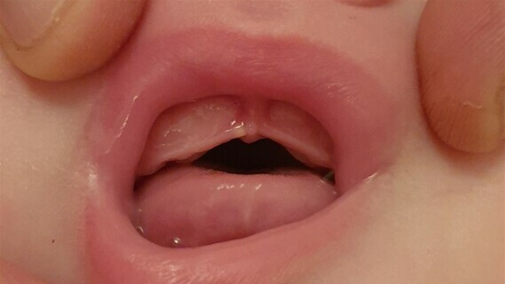 كل ما عليك معرفته عن لآلئ ابشتاين عند حديثي الولادة 