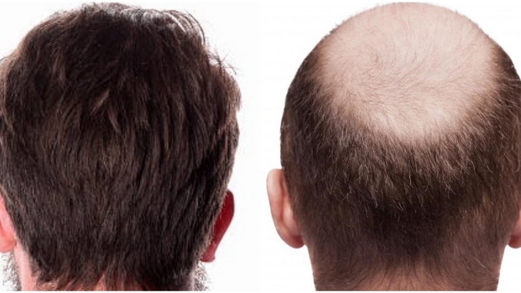إلى الراغبين بإجراء عملية زراعة الشعر... هذه المقالة لكم!