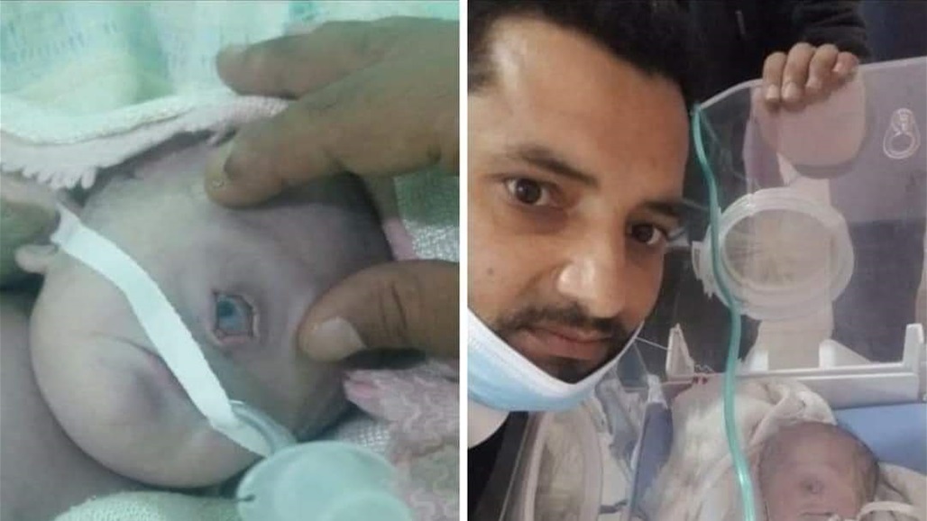 بعد 7 ساعات من ولادته.. وفاة الطفل اليمني صاحب العين الواحدة (صور)