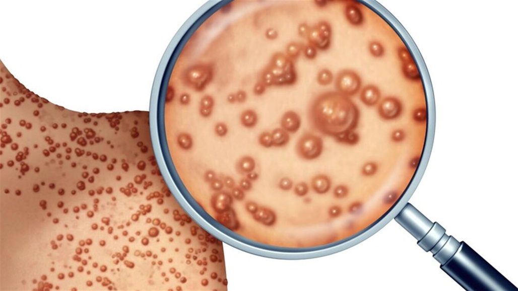 6 رسومات تكشف تغييرات في الجلد تدل على الإصابة بـ"جدري القردة"