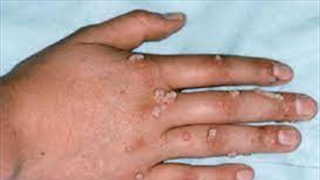 توضيح جديد من الصحة العالمية بشأن "جدري القردة"