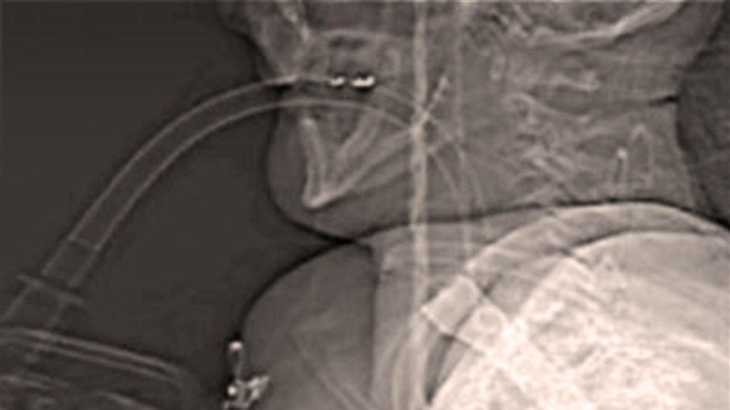 نجا بأعجوبة بعد طعنه بسكين مطبخ استقر في حلقه!