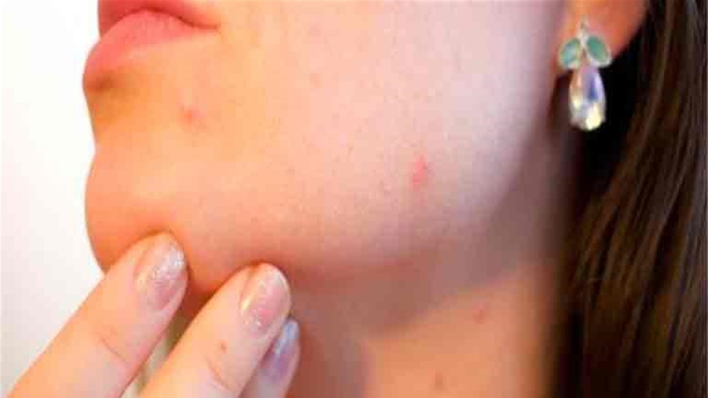 علامة تظهر داخل الفم تدل على الإصابة بجدري القردة