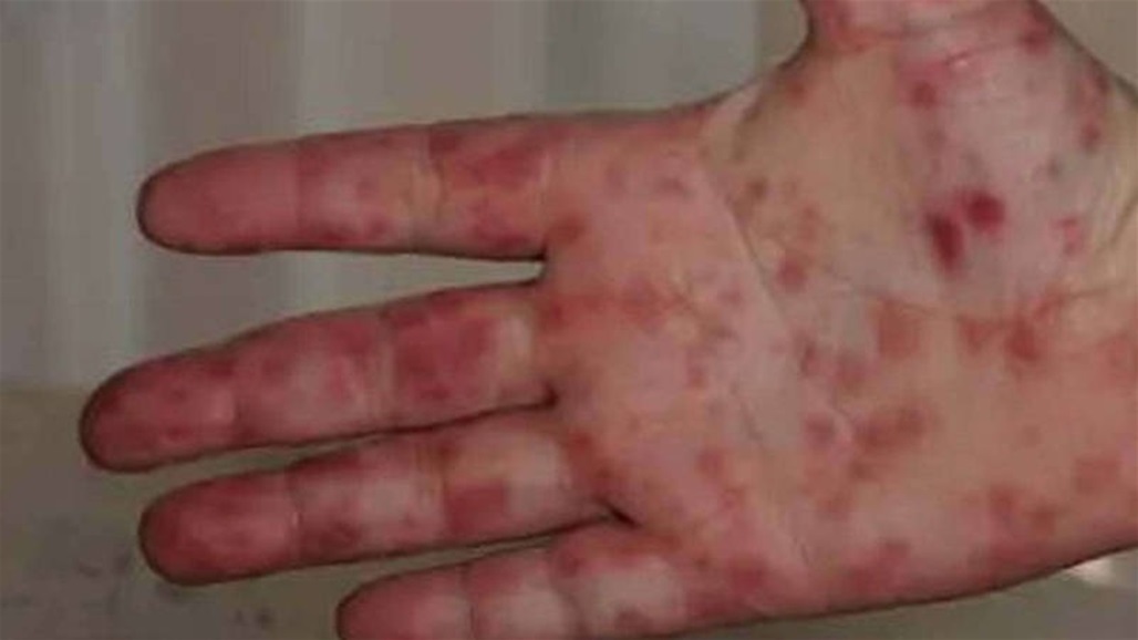 إنفلونزا الطماطم تنتشر... هل من داع للهلع؟