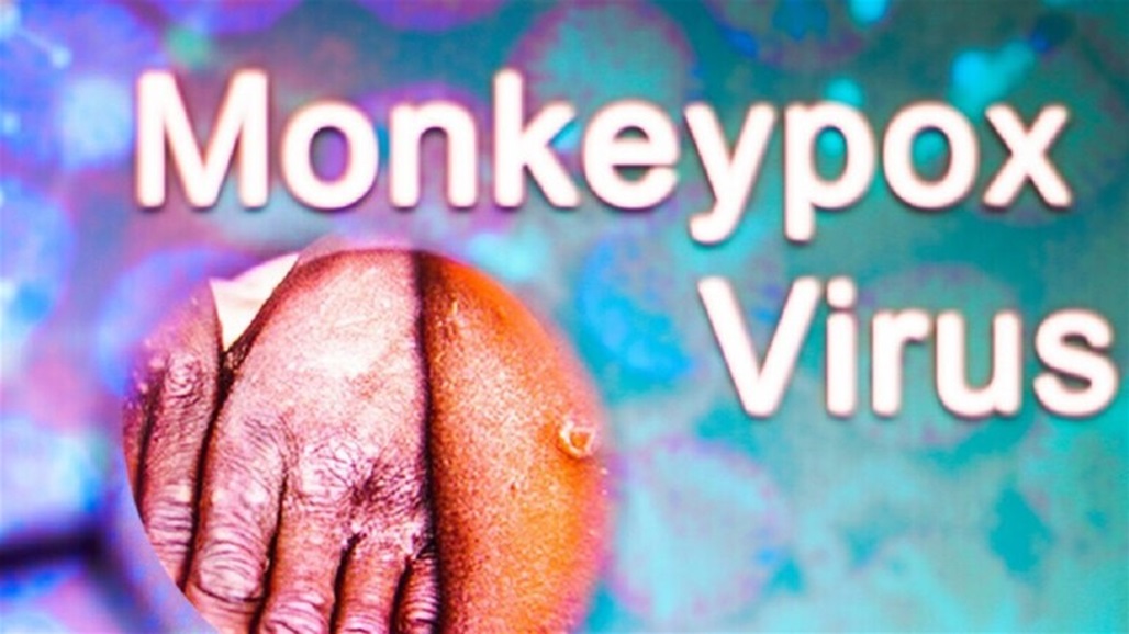 خبير يكشف معلومات عن فيروس جدري القردة ومدى خطورته