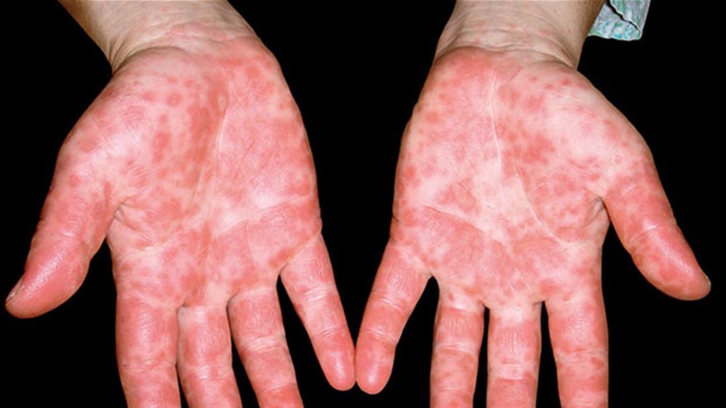 فيروس غامض ينتشر في دولة آسيوية