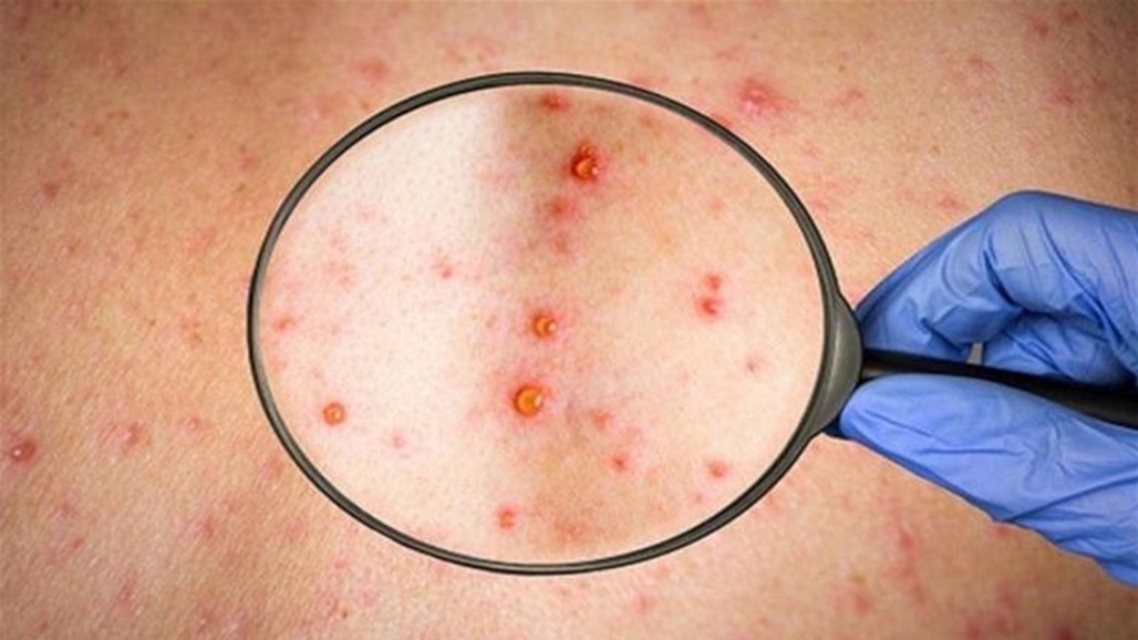 دراسة تكشف تاثير "جدري القردة" على القلب