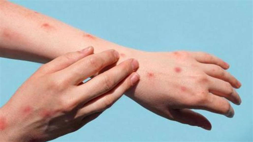تسجيل اول حالة إصابة بجدري القرود في الصين