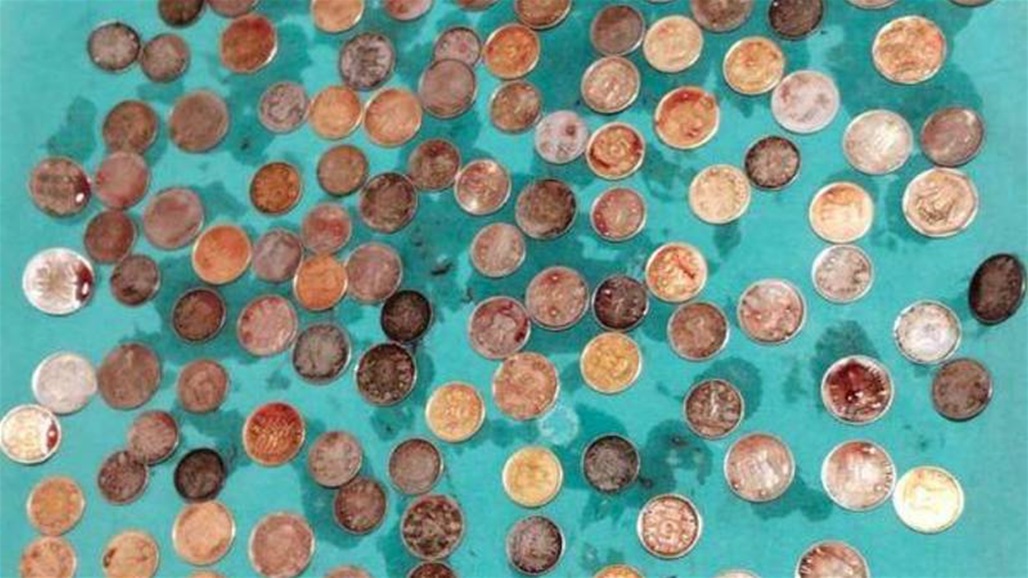 ابتلعها بسبب سوء حالته النفسية.. إخراج 187 قطعة نقدية من معدة رجل