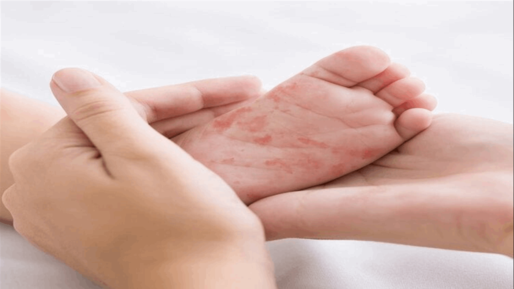 علاج جديد يبشر بنهاية معاناة مصابين بمرض "انحلال البشرة الفقاعي"
