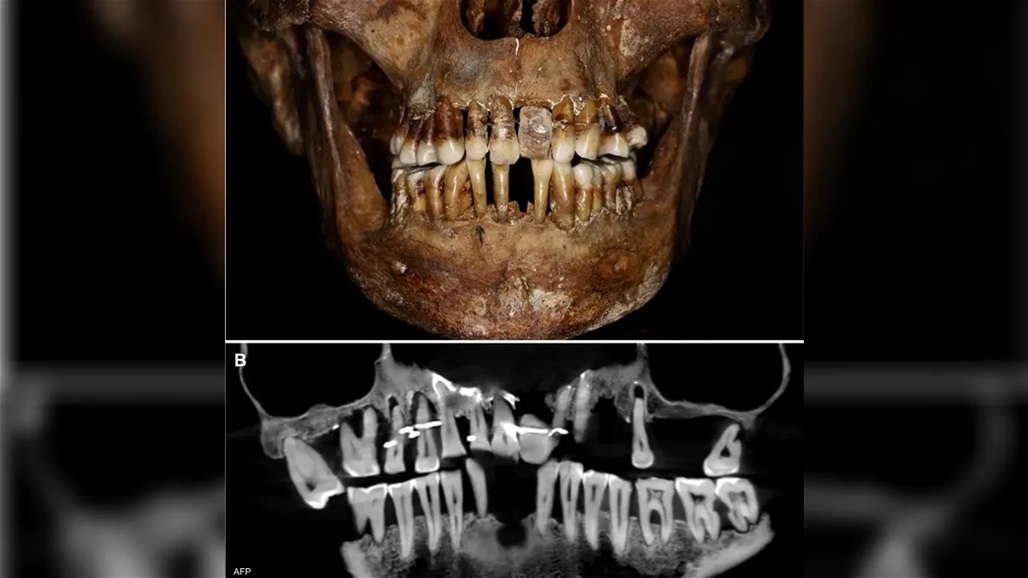 توفيت قبل 400 عام.. طريقة اعتمدتها فرنسية للحفاظ على أسنانها