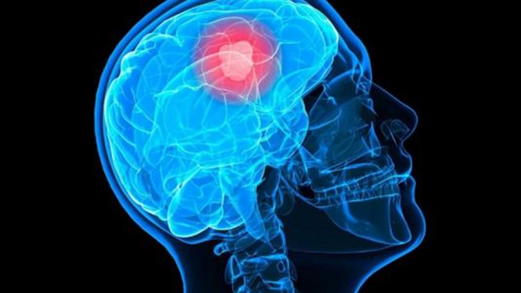 الذكاء الاصطناعي يطور أداة يمكنها تشخيص سرطان الدماغ في 90 ثانية