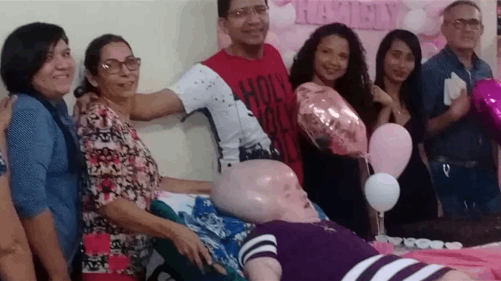 امرأة برازيلية تعاني من مرض نادر يسبب لها استمرار نمو رأسها
