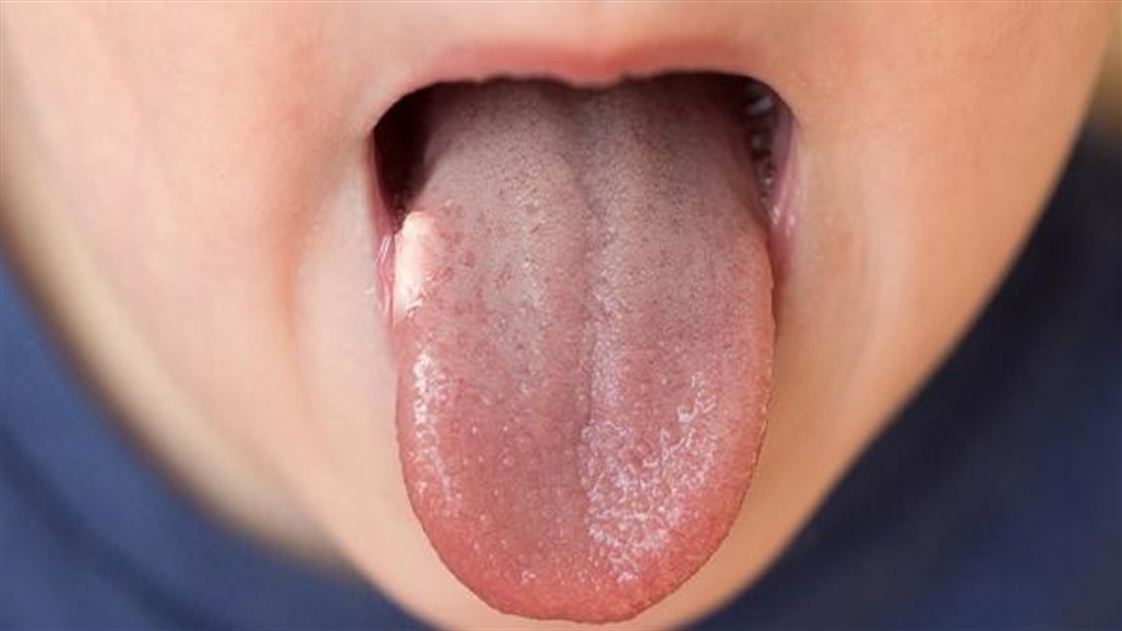 يُصيب الرجال عادة.. ما أهم أسباب سرطان اللسان؟  