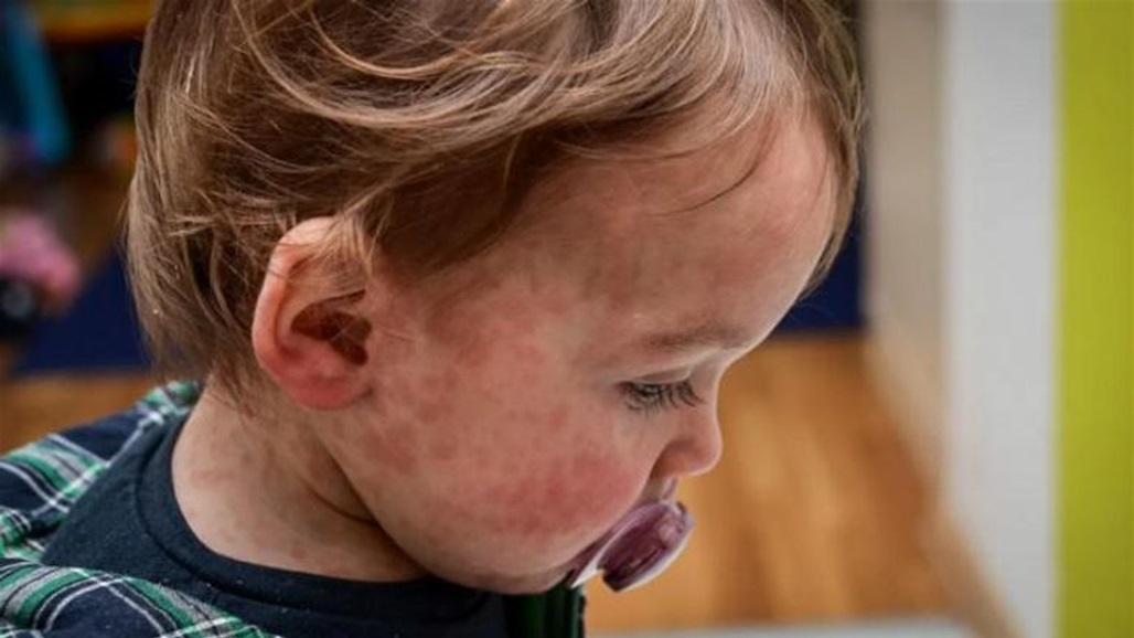 سريع الانتشار.. ذعر في بريطانيا بسبب تفشي فيروس جديد 