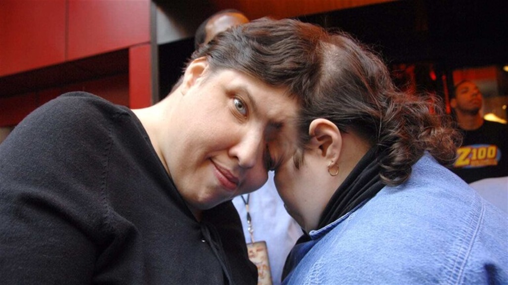 رفضا الانفصال واحدهم متحول جنسي.. وفاة أكبر توأم ملتصق بالعالم 