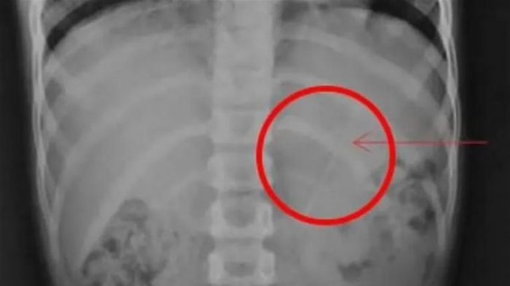 بطول 10 سم.. طفل يبتلع قلم رصاص لمدة 8 ساعات 