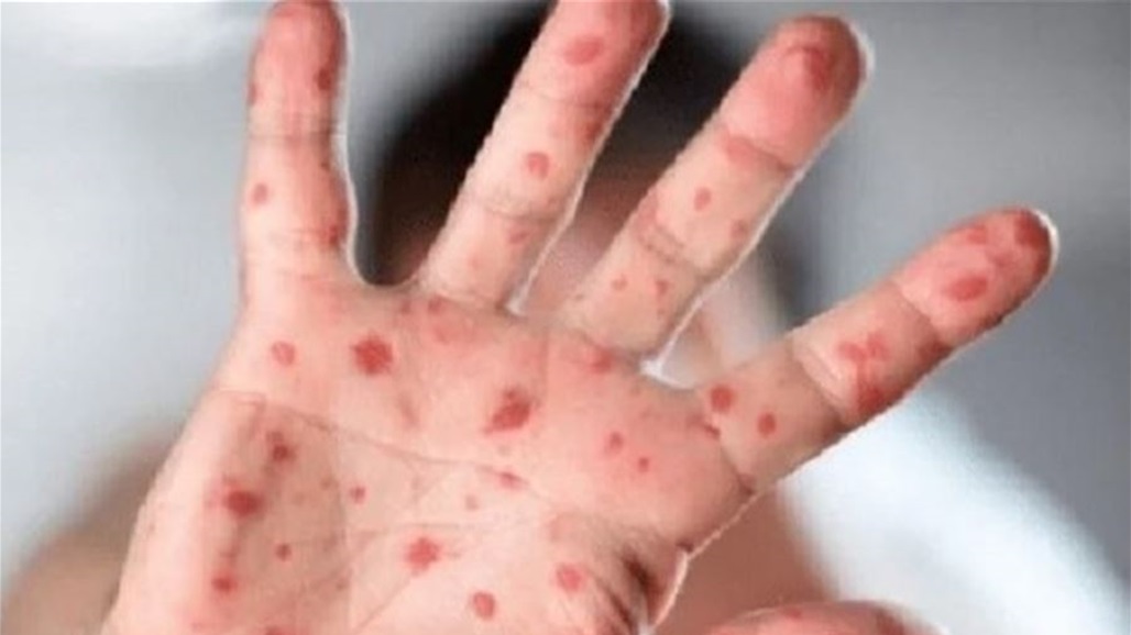 الصحة العالمية تطلق خطة لوقف انتشار "جدري القردة"