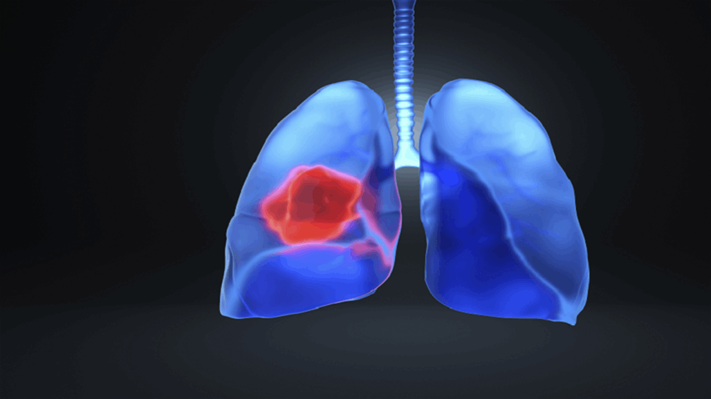 "تهديد صامت" يصيب غير المدخنين بسرطان الرئة.. هل تعرفه؟