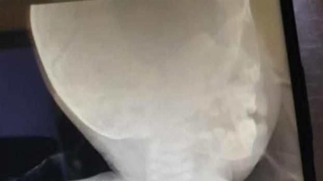 نينوى.. انقاذ طفل ابتلع حبة زيتون