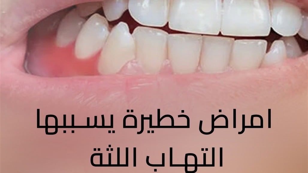 امراض خطيرة يسببها التهاب اللثة.. فيديوغراف