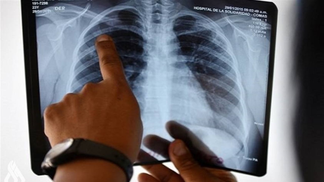 الذكاء الاصطناعي &quot;سرّع الكشف&quot;.. الصحة: العراق تفوّق على النسبة العالمية لعلاج التدرن وبلغت 94%