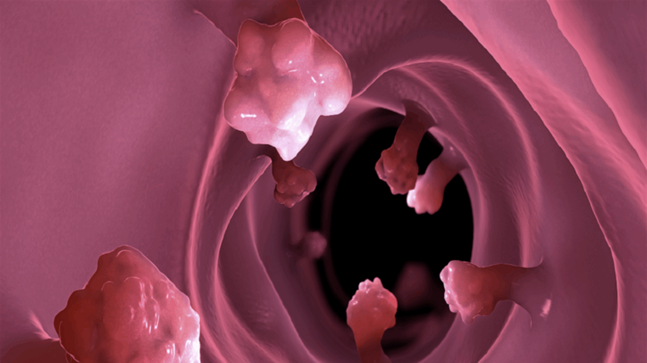 أكثر من 100 نوع.. أدوية تهدد الأمعاء بالسرطان