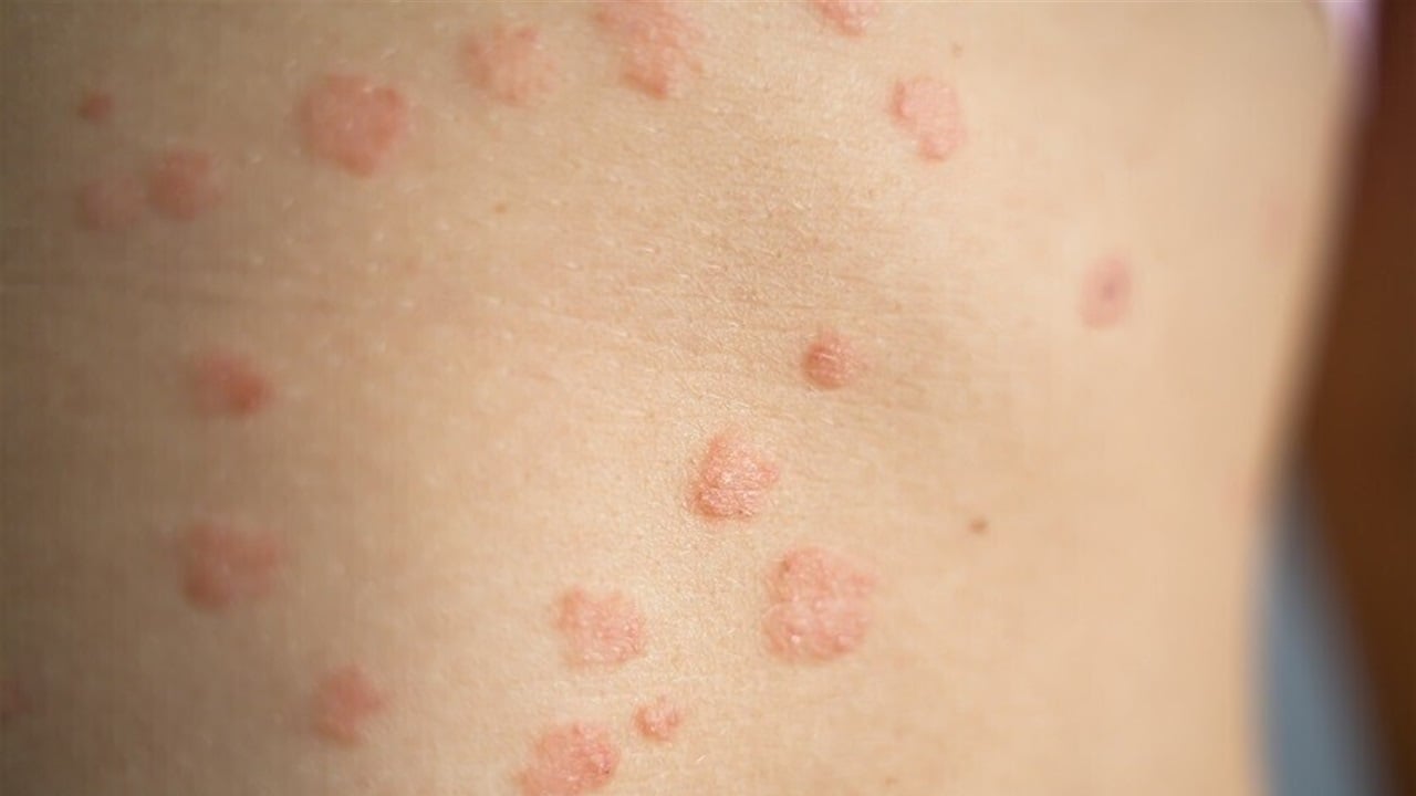 اوروبا تحت تهديد &quot;الفطر الفائق&quot;.. مقاومة للأدوية وانتشار سريع!