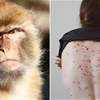 بريطانيا توفر "لقاح الجدري" لمرض "جدري القرود"