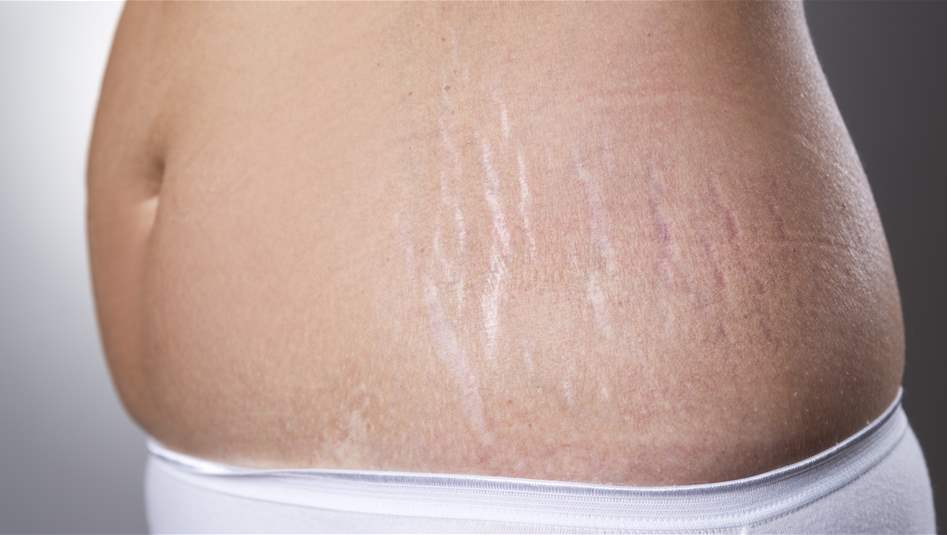 7 خلطات طبيعية للتخلص من تشققات الجلد