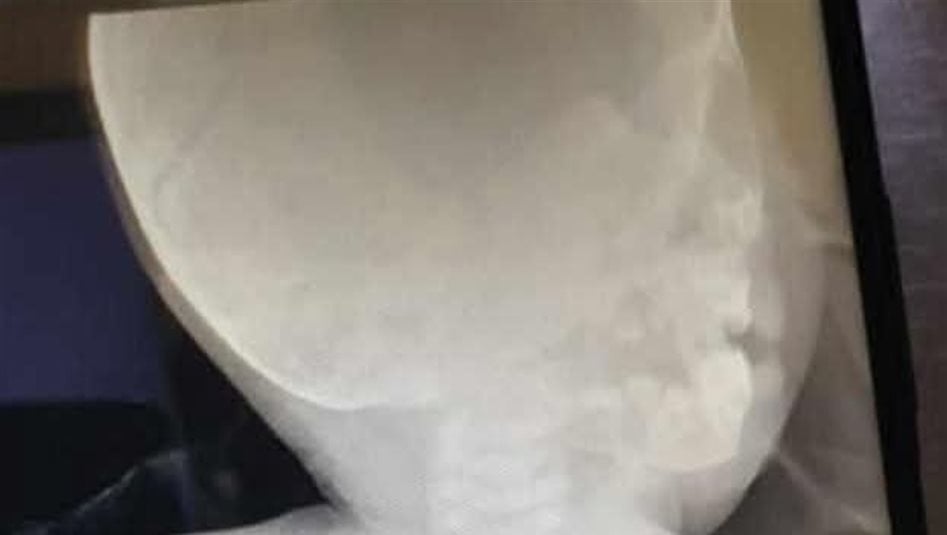 نينوى.. انقاذ طفل ابتلع حبة زيتون