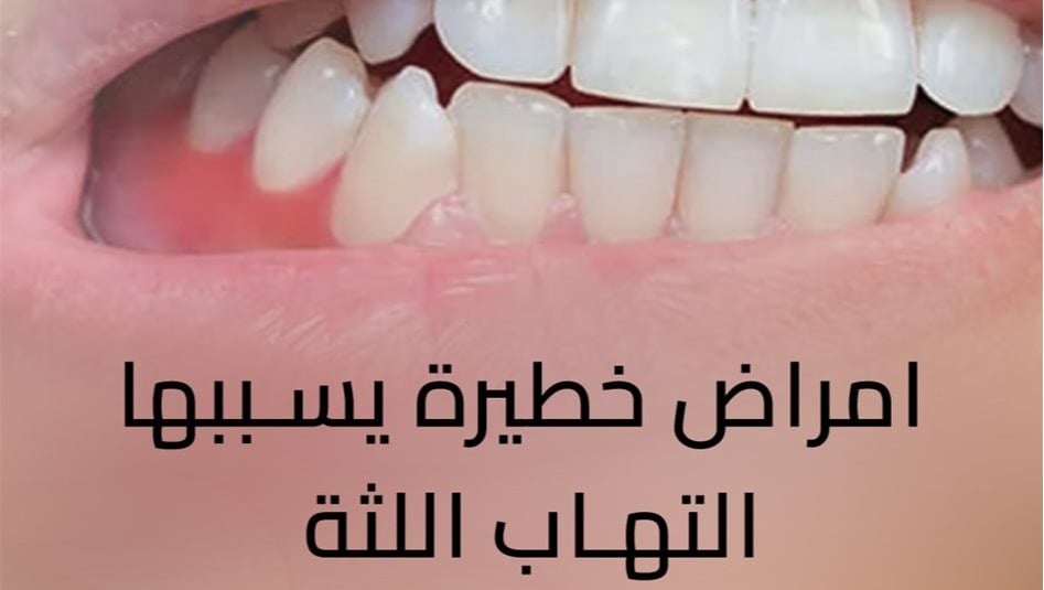 امراض خطيرة يسببها التهاب اللثة.. فيديوغراف