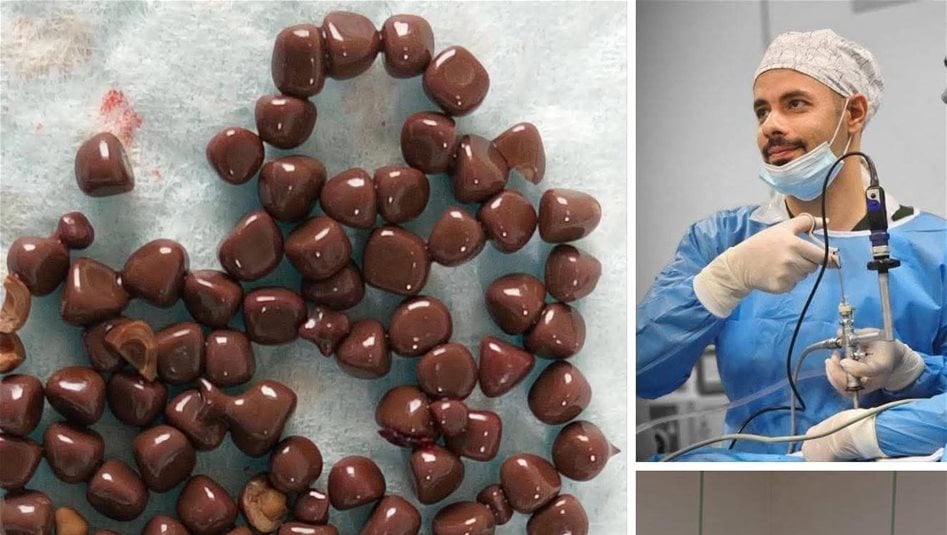 اعجاز طبي عراقي جديد.. استخراج أكثر من 100 حصوة من كلية مريض 