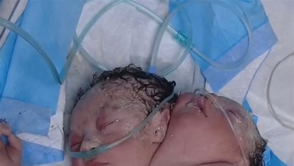 في مستشفى اليرموك.. ولادة نادرة لتوأم ملتصق بعملية قيصرية معقدة (صورة) 